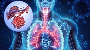 مراقبت حاد تنفسی همگان