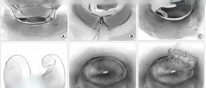 Tympanoplasty4