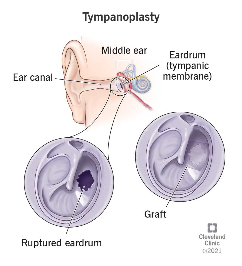Tympanoplasty1