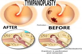 Tympanoplasty2