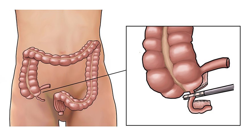 Appendectomy