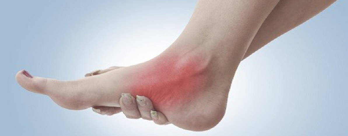 پیچ خوردگی مچ پا