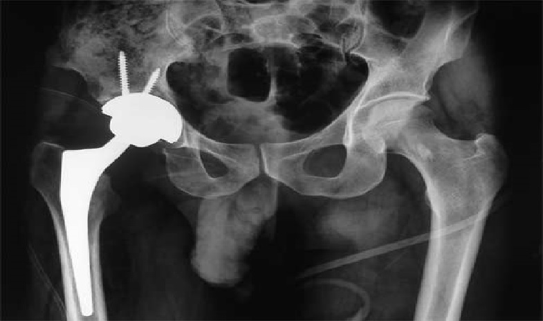 جراحی تعویض مفصل ران
