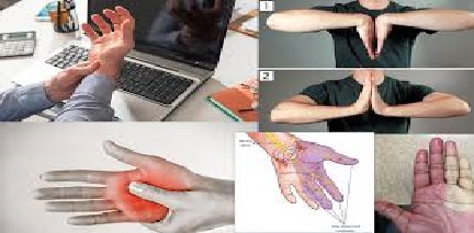 سندرم تونل مچ دست