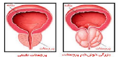 همه چیز درباره پروستات