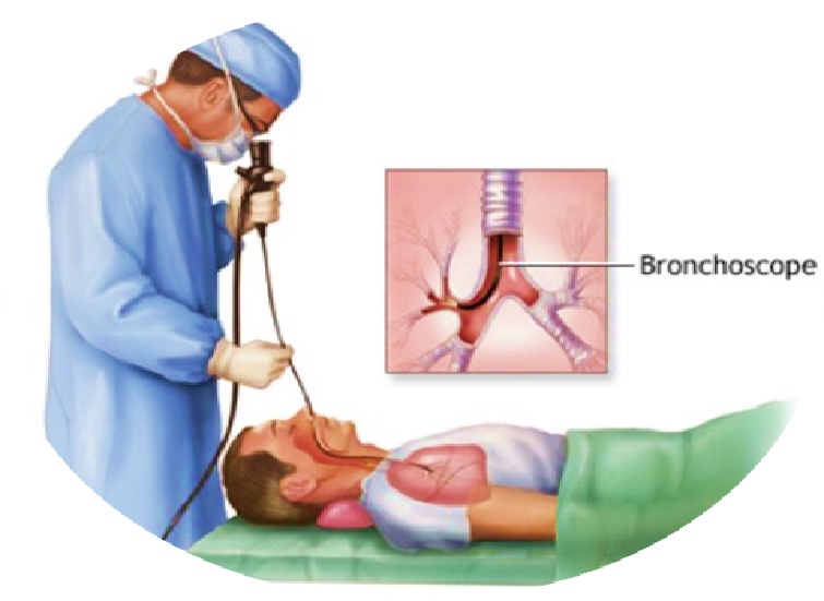 برونکوسکوپی