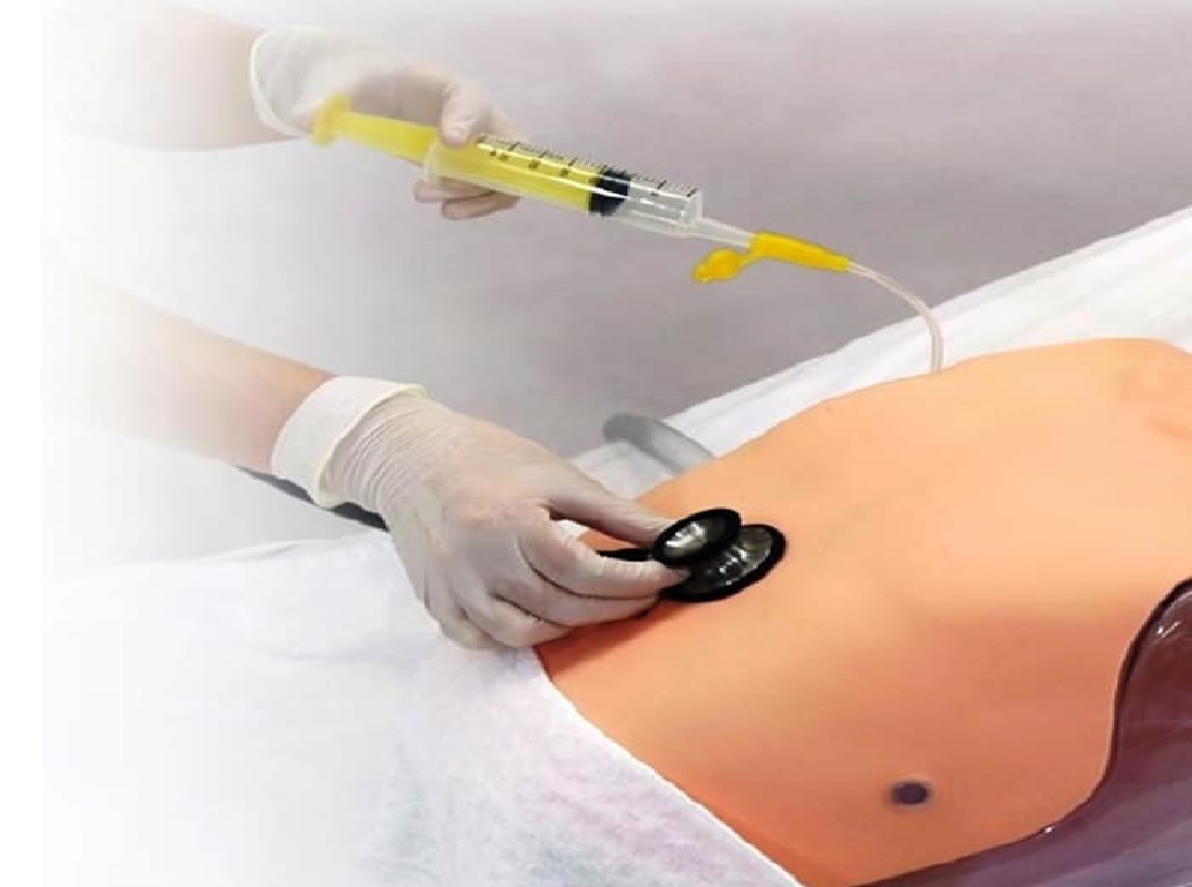 تغذیه از طریق پگ