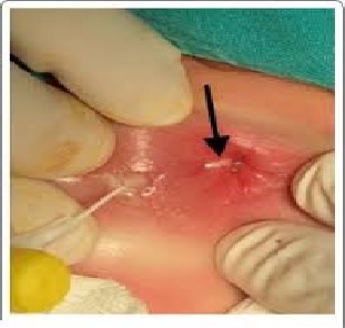 اصول مراقبت‌های پس از جراحی فیشر و هموروئید