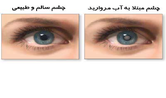 مراقبت های بعد از عمل کاتاراکت یا آب مروارید