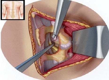 جراحی دیسک کمر