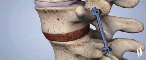 مراقبت بعد از جراحی فیوژن  کمر