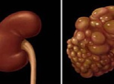 بیماری کلیه پلی کیستیک و گلومرونفریت