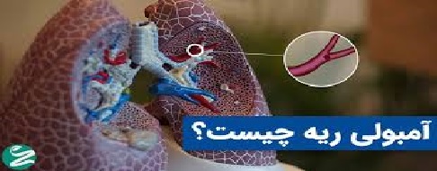 آمبولی ریه