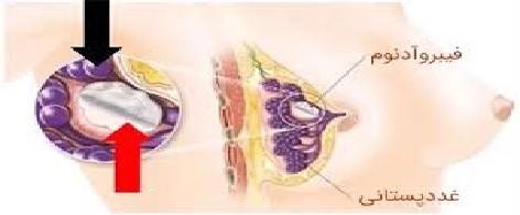 انواع توده‌ها ی پستان