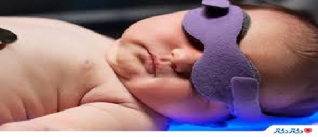 زردی نوزادان