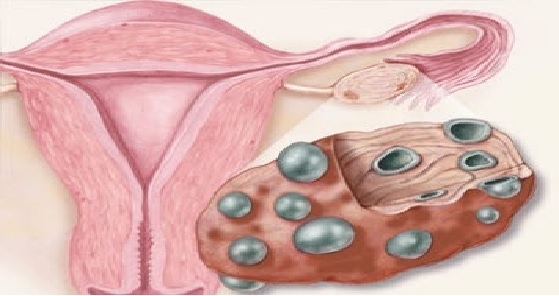 سندرم تخمدان پلی کیستیک