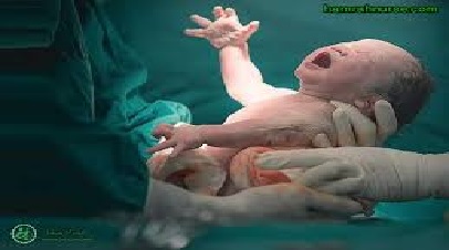 مراقبت‌های بعد از سزارین