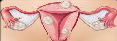 مایومکتومی