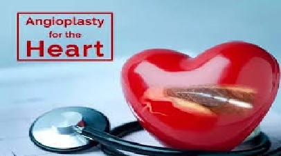 آنژیوپلاستی